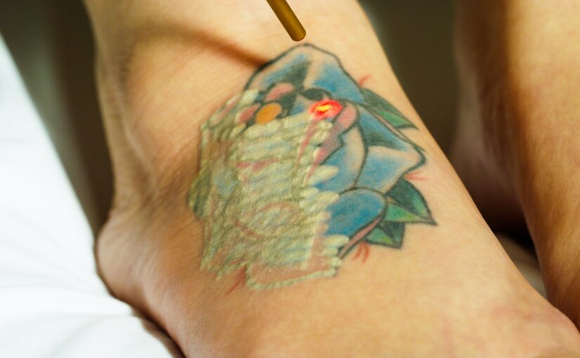 Harnessing the Power: Unleashing the Magic of Laser Tattoo Removal